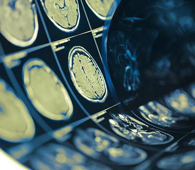 Concussion Concussion